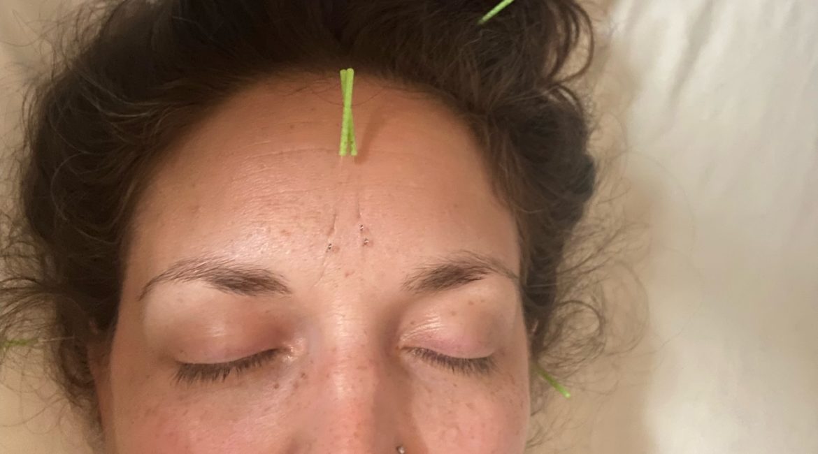 Close up image of light-skinned woman with peachy-olive complexion and dark hair in a messy bun on top of her head. Her eyes are closed and several acupuncture needles with neon yellowish-green ends stick out from her forehead and sides of her cheeks. Smaller intradermal needles that look like teeny silver balls are also visible along the forehead and between the eyebrows. The top of a hospital type gown is also slightly in the frame.